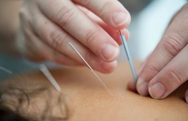 acupuncture et stress